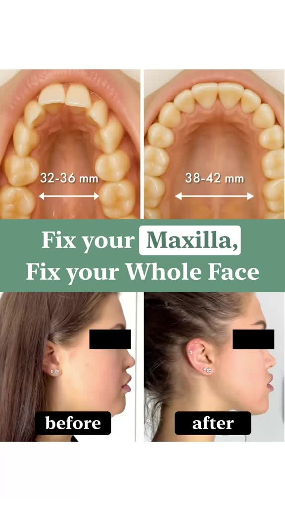 ✨ Fix your Maxilla, Fix your Whole Face ✨ Your maxilla = your upper jaw. It’s also called the “beauty bone” – because it
